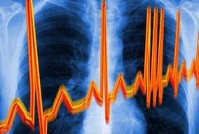 srčna aritmija za osteohondrozo